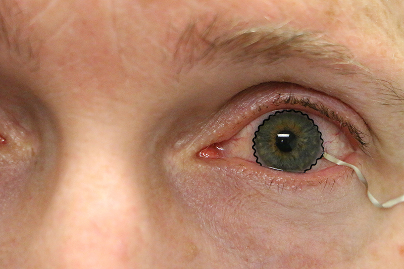 Contact lens in eye